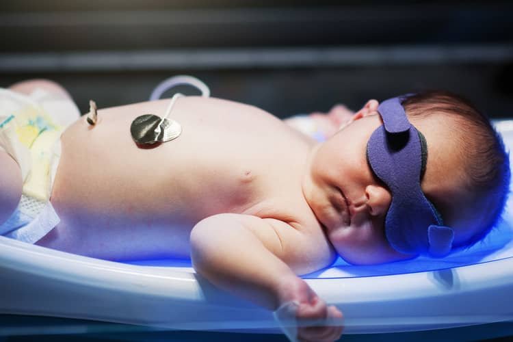 Novorodenecká žltačka fototerapia