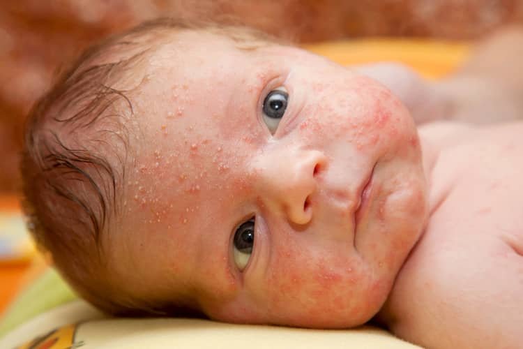 Čo je to novorodenecké akné?