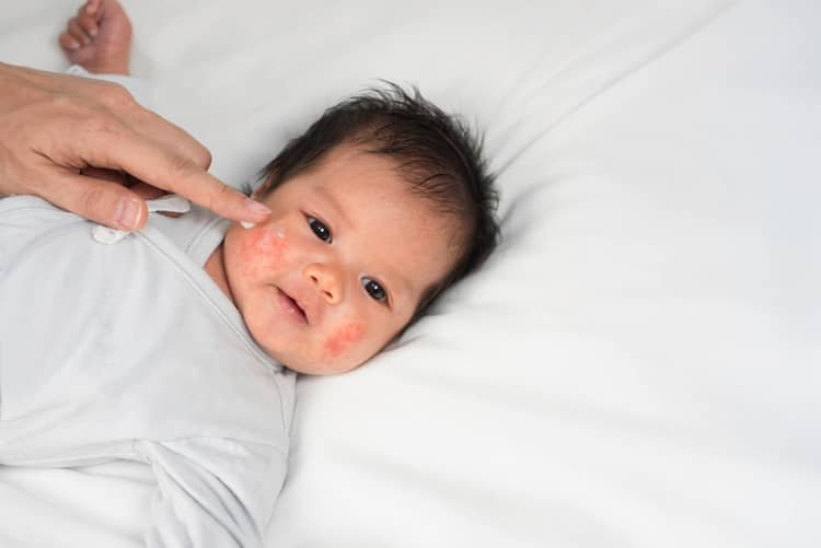 Novorodenecké vs dojčenské akné