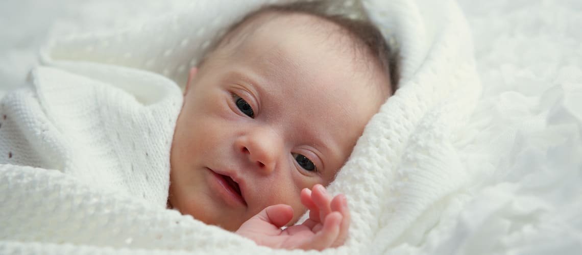 Aké sú príznaky Downovho syndrómu u novorodenca?