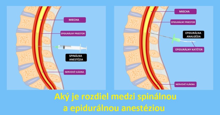 Spinálna vs epidurálna anestézia