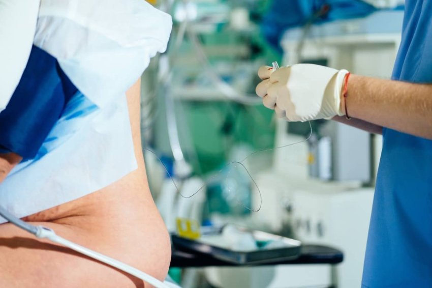 Účinnosť epidurálky pri pôrode