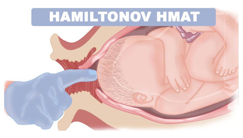 Hamiltonov Hmat na vyvolanie pôrodu