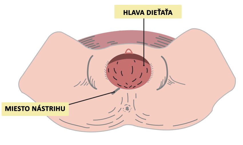 ako vyzerá nástrih hrádze obrázok