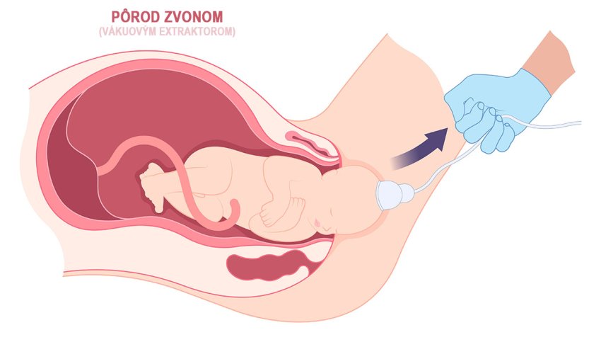 pôrod zvonom - vákuovým extraktorom