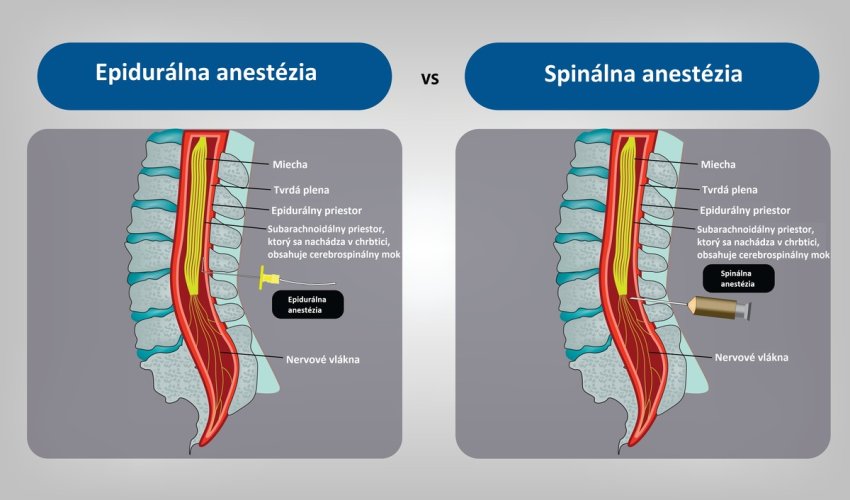 Epidurálna vs spinálna anestézia