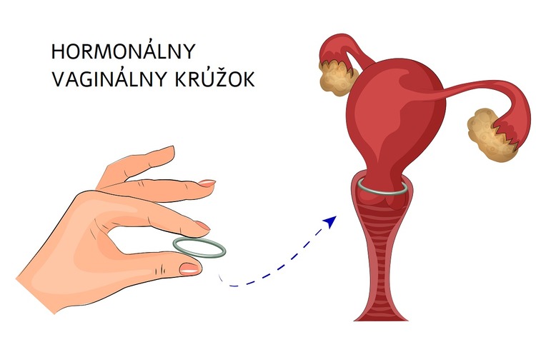 Hormonálny vaginálny krúžok