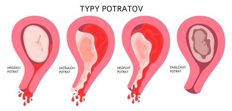 Typy potratov