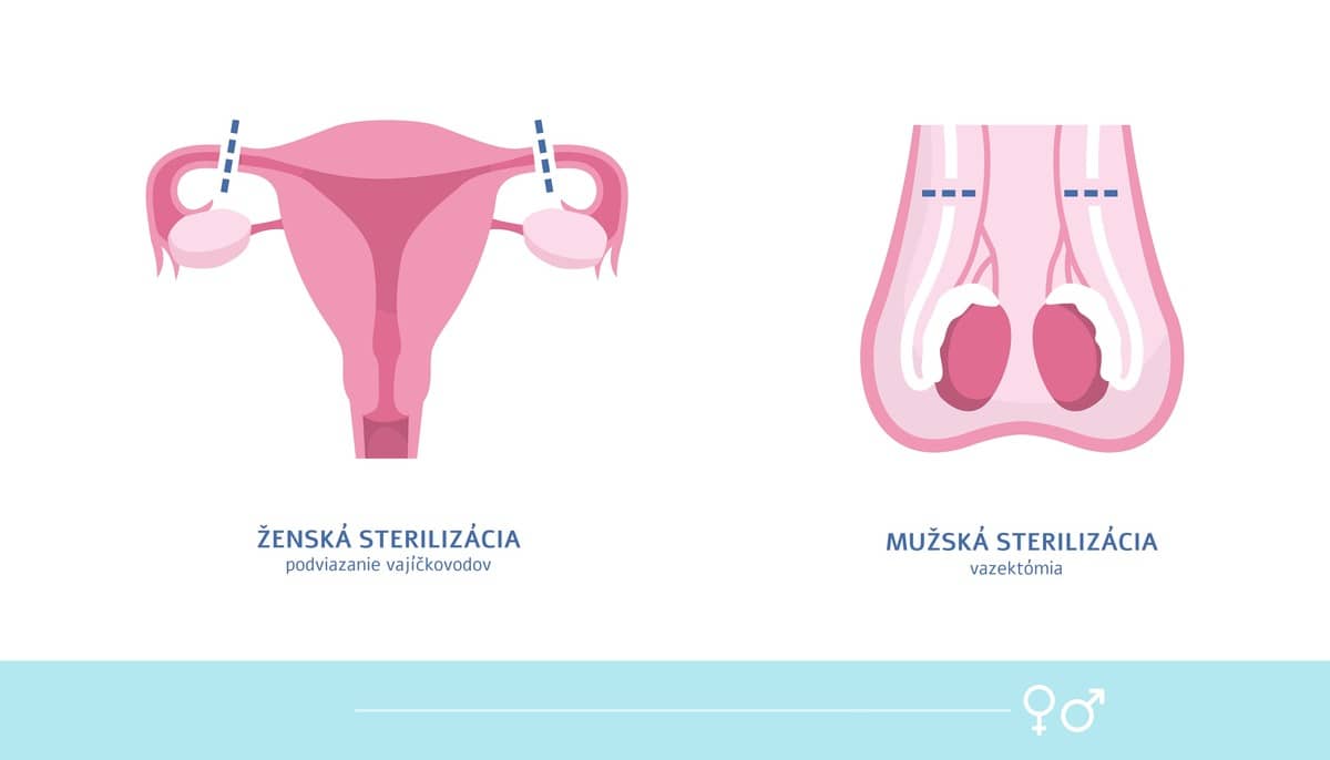 Sterilizácia ženy vs sterilizácia muža