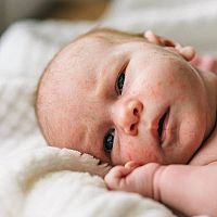 Novorodenecké akné na tvári