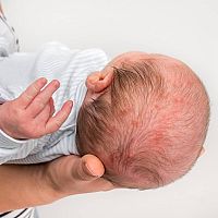Novorodenecké akné vo vlasoch
