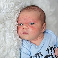 Baby akné na tvári