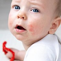 Novorodenecké akné liečba