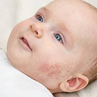 Novorodenecké akné na lícach