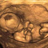 Morfologický ultrazvuk 3D