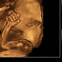 Morfologický ultrazvuk 4D