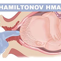 hamiltonov hmat na vyvolanie pôrodu