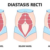 Diastáza typy