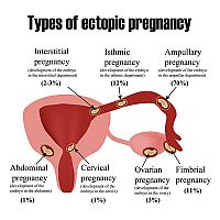 Typy mimomaternicového tehotenstva