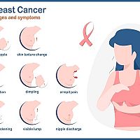 Hrčka na prsníku a rakovina